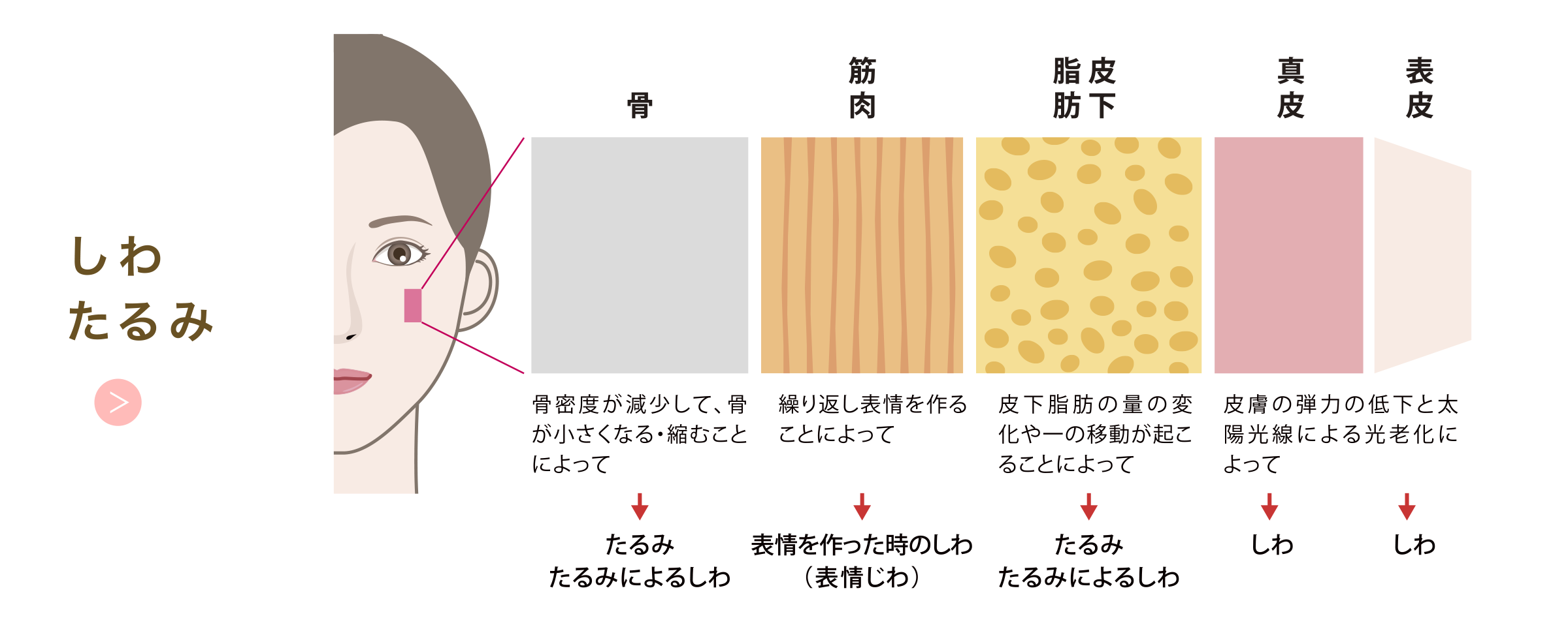 しわたるみのできる層