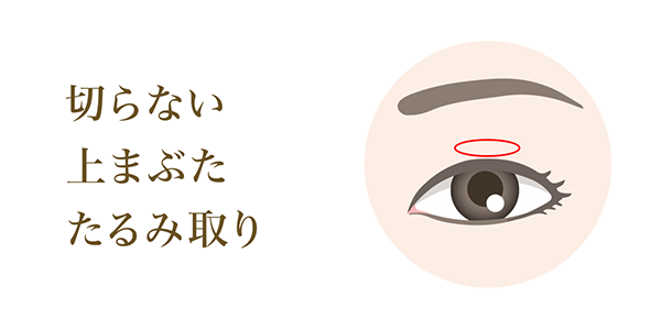 切らない 上まぶた たるみ取り