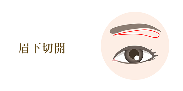 眉下切開