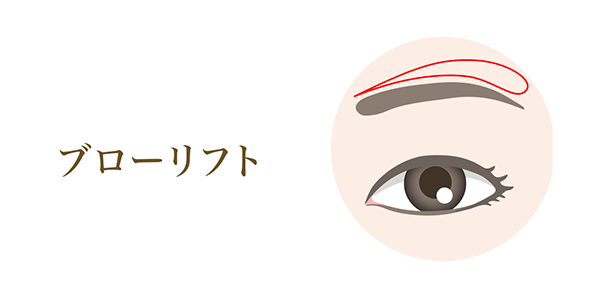 ブローリフト