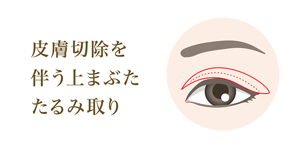 皮膚切除を 伴う上まぶた たるみ取り