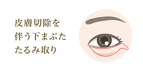 皮膚切除を 伴う下まぶた たるみ取り
