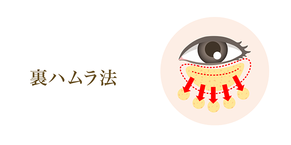 裏ハムラ法