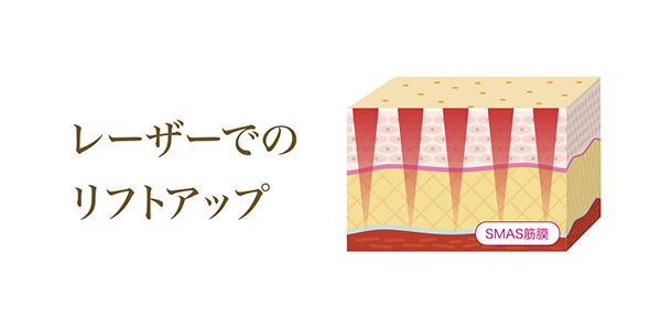 レーザーでのリフトアップ