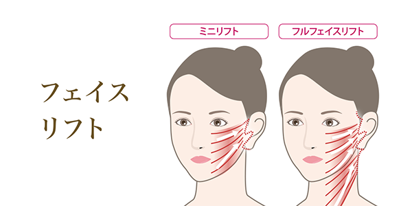 フェイスリフト