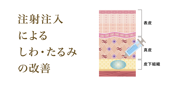 注射注入によるしわ・たるみの改善