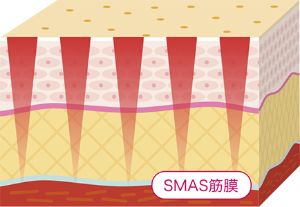 レーザーによるリフトアップ