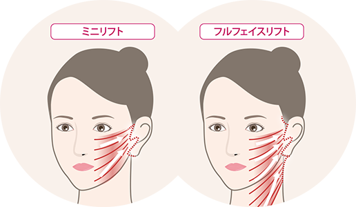 フェイスリフト