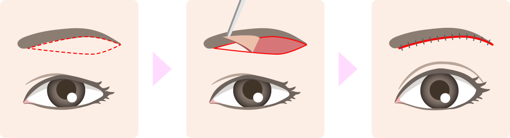 眉下切開施術方法