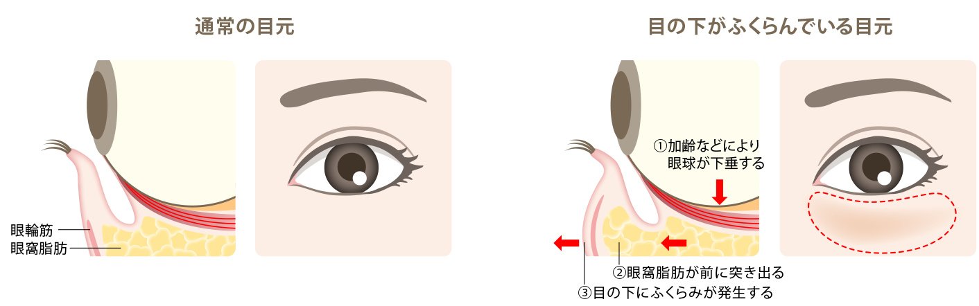 ブローリフトイメージ