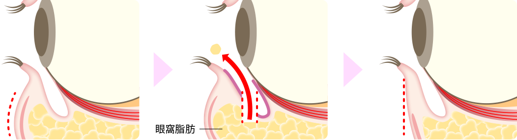 下眼瞼脱脂(経結膜脱脂)施術方法
