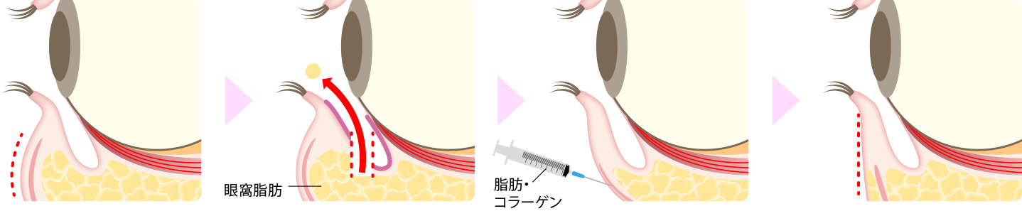 下眼瞼脱脂(経結膜脱脂)同時注入