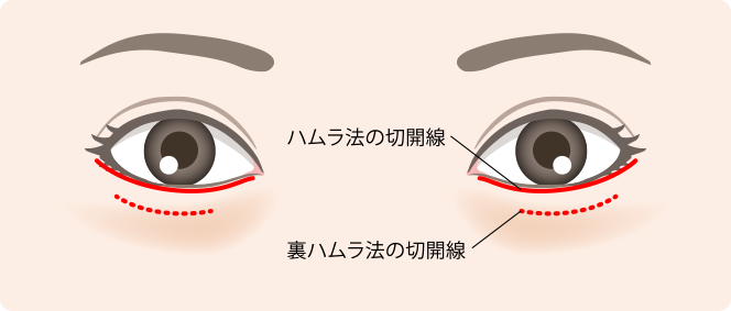 裏ハムラ法イメージ