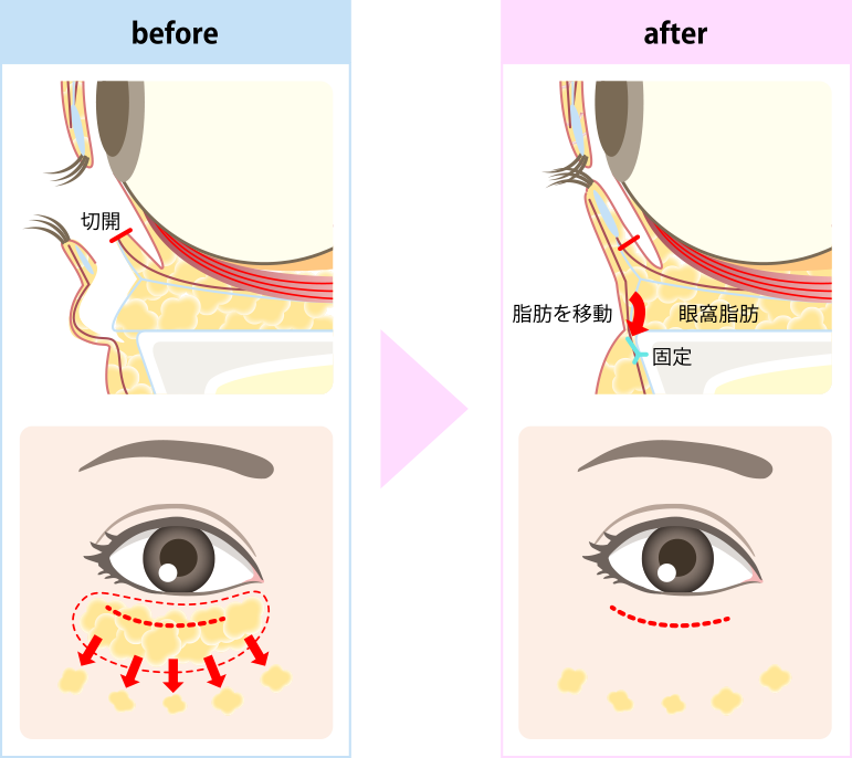 裏ハムラ法施術方法